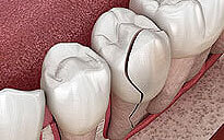 Tooth-Repair-And-Replacement
